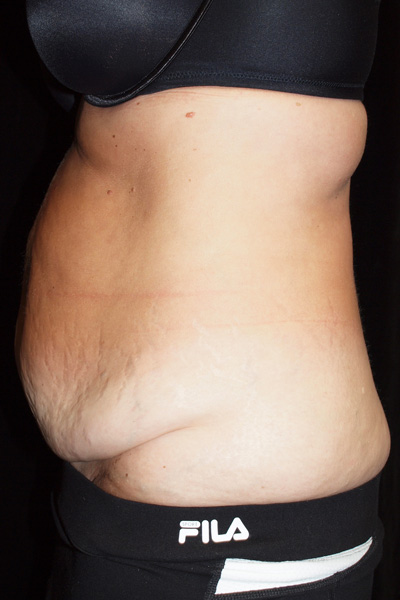 Abdominoplasty - Laser and Classic - Body Surgery - Dr Ciric